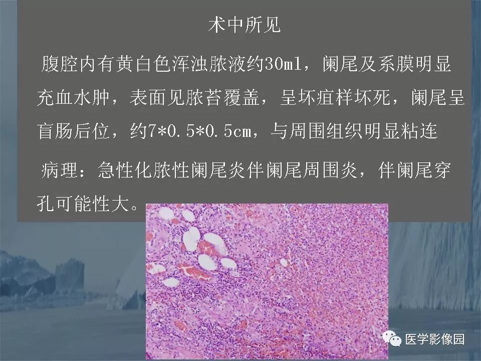 影像PPT - 【PPT】阑尾炎的CT诊断-38