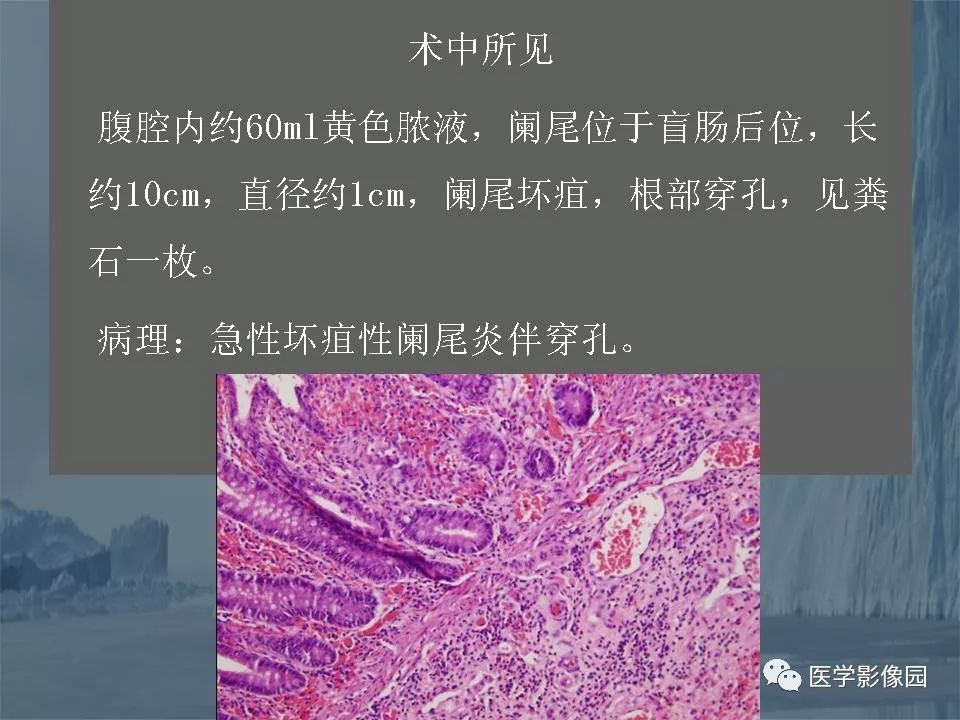 影像PPT - 【PPT】阑尾炎的CT诊断-42
