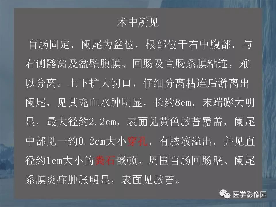 影像PPT - 【PPT】阑尾炎的CT诊断-45
