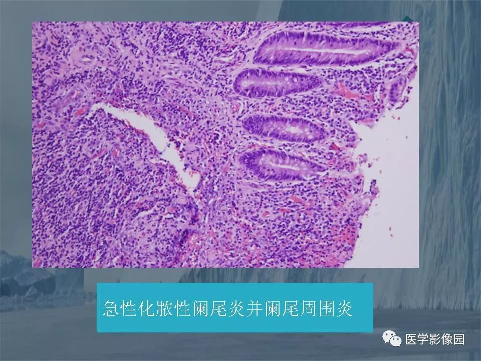 影像PPT - 【PPT】阑尾炎的CT诊断-46