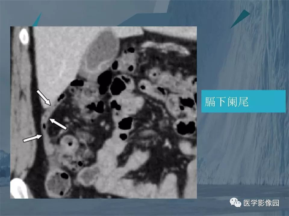 影像PPT - 【PPT】阑尾炎的CT诊断-49