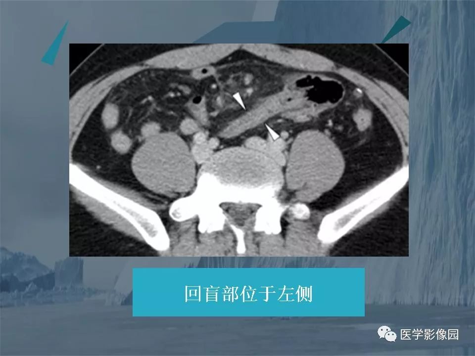 影像PPT - 【PPT】阑尾炎的CT诊断-50