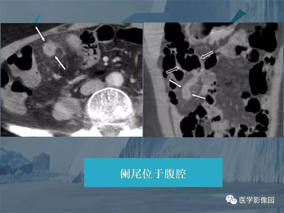 影像PPT - 【PPT】阑尾炎的CT诊断-51