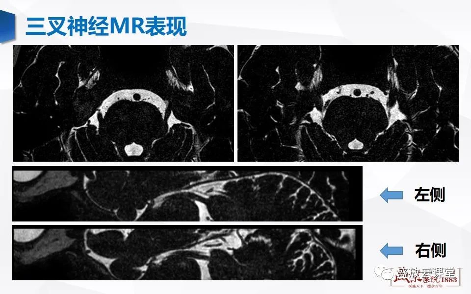 影像PPT - 【PPT】MR对三叉神经的评价-9