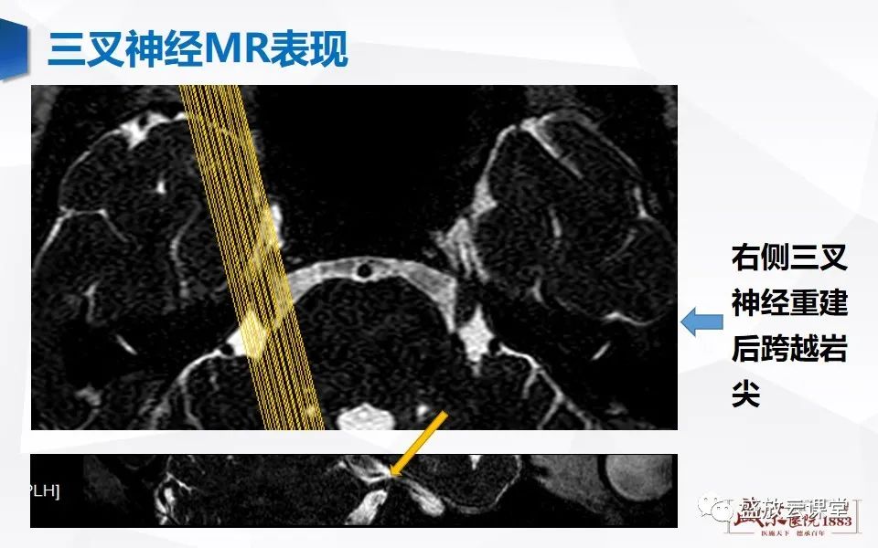 影像PPT - 【PPT】MR对三叉神经的评价-10