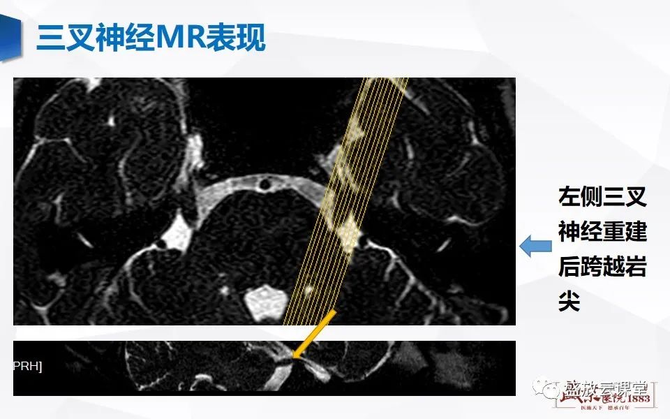 影像PPT - 【PPT】MR对三叉神经的评价-11