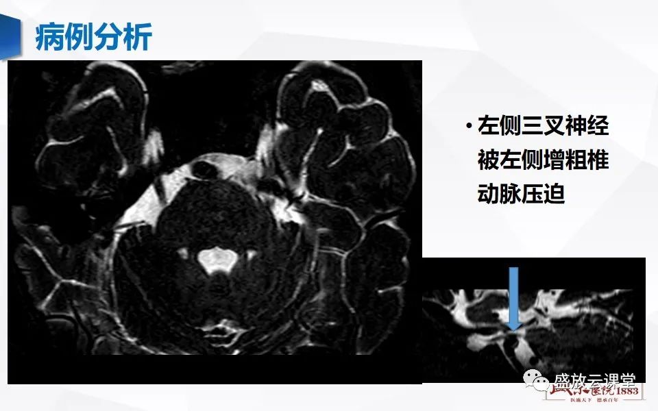 影像PPT - 【PPT】MR对三叉神经的评价-17