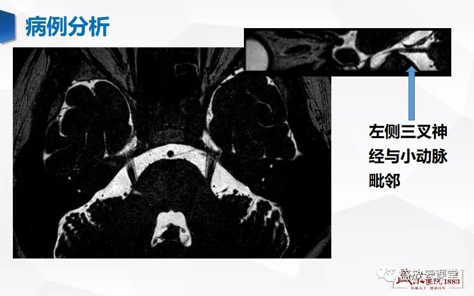影像PPT - 【PPT】MR对三叉神经的评价-16