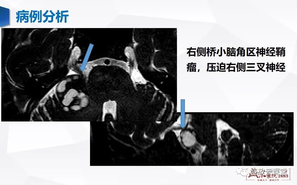 影像PPT - 【PPT】MR对三叉神经的评价-18