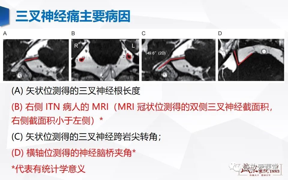 影像PPT - 【PPT】MR对三叉神经的评价-14