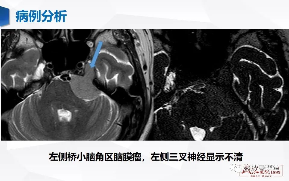 影像PPT - 【PPT】MR对三叉神经的评价-19