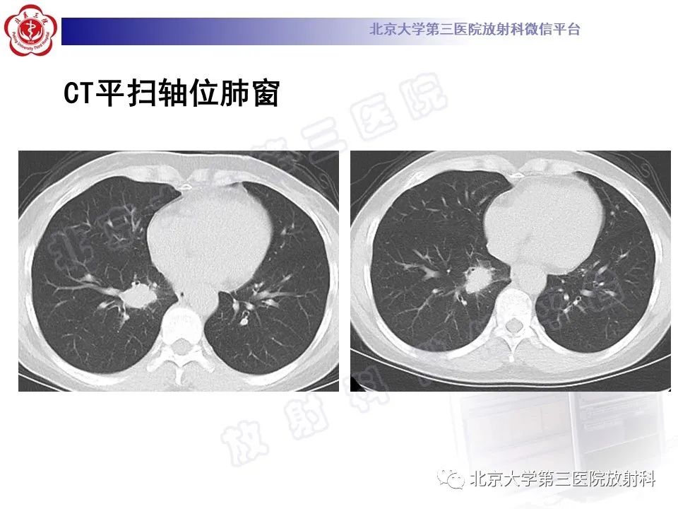 影像PPT - 【PPT】原发性肺淋巴上皮瘤样癌-3