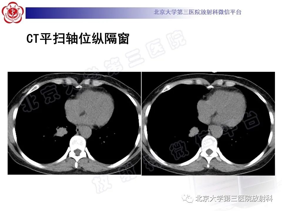 影像PPT - 【PPT】原发性肺淋巴上皮瘤样癌-4