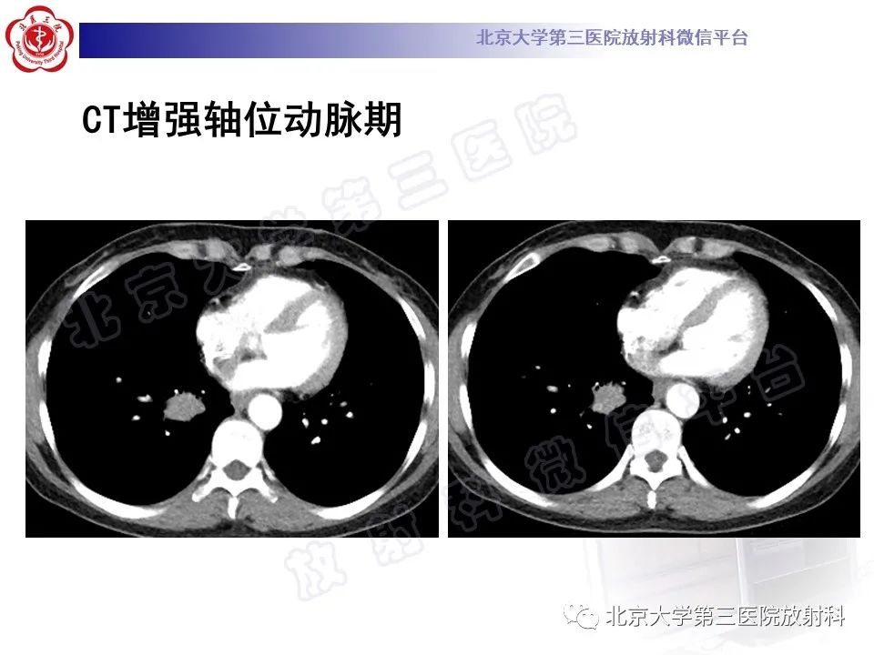 影像PPT - 【PPT】原发性肺淋巴上皮瘤样癌-5