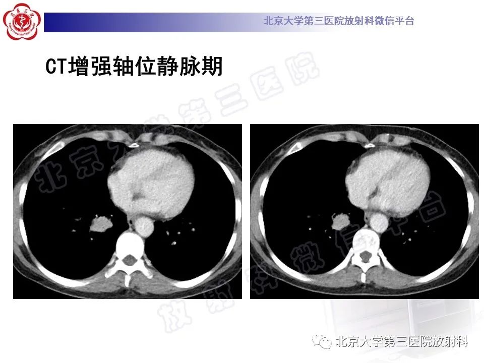 影像PPT - 【PPT】原发性肺淋巴上皮瘤样癌-6