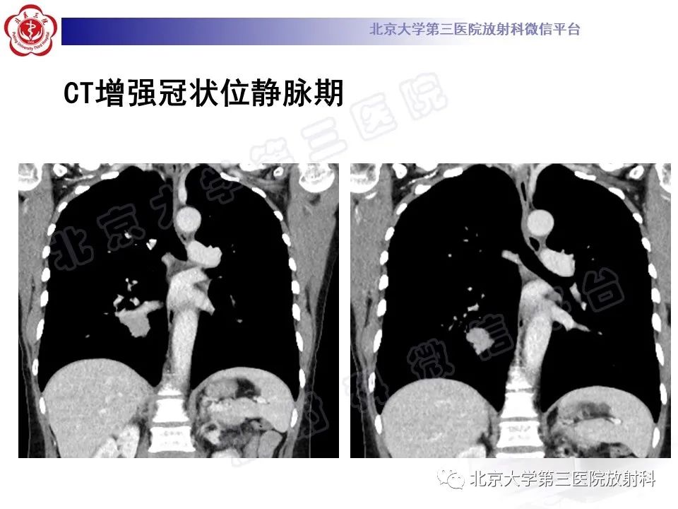 影像PPT - 【PPT】原发性肺淋巴上皮瘤样癌-8