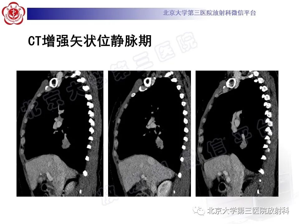 影像PPT - 【PPT】原发性肺淋巴上皮瘤样癌-7