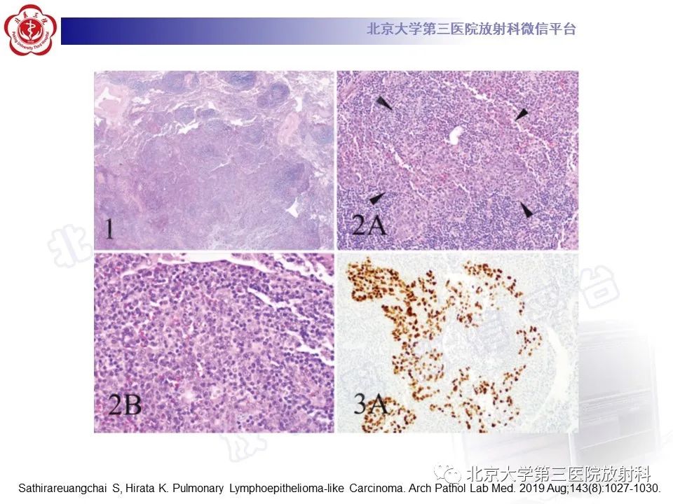 影像PPT - 【PPT】原发性肺淋巴上皮瘤样癌-16