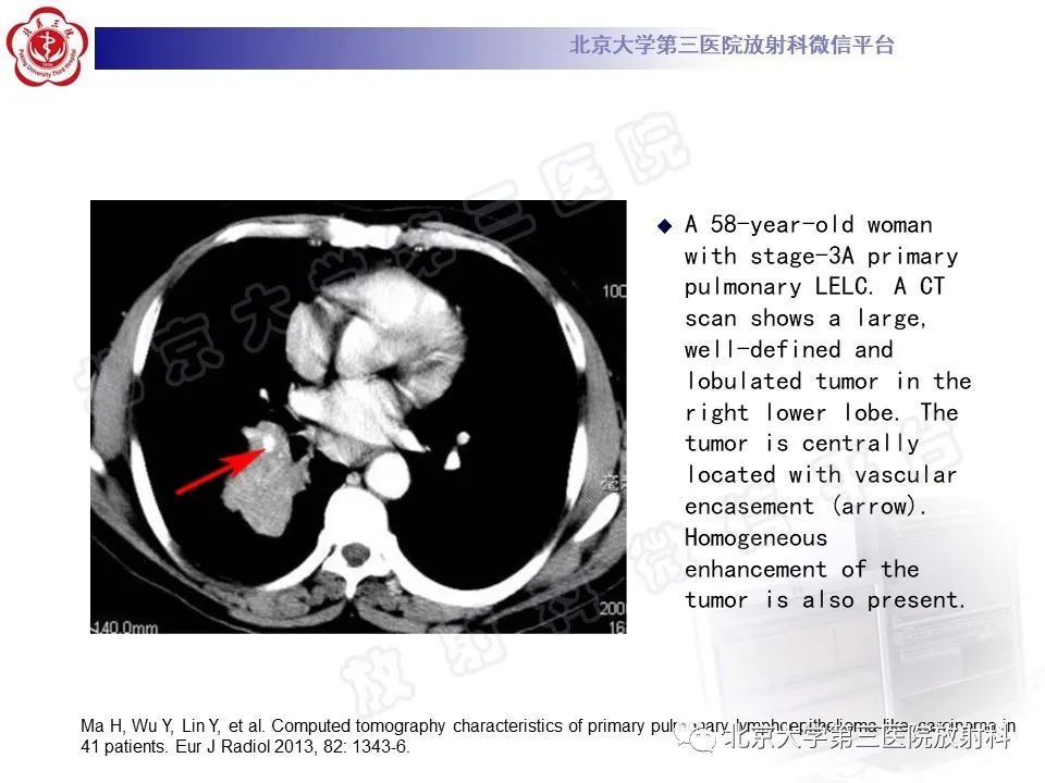 影像PPT - 【PPT】原发性肺淋巴上皮瘤样癌-19