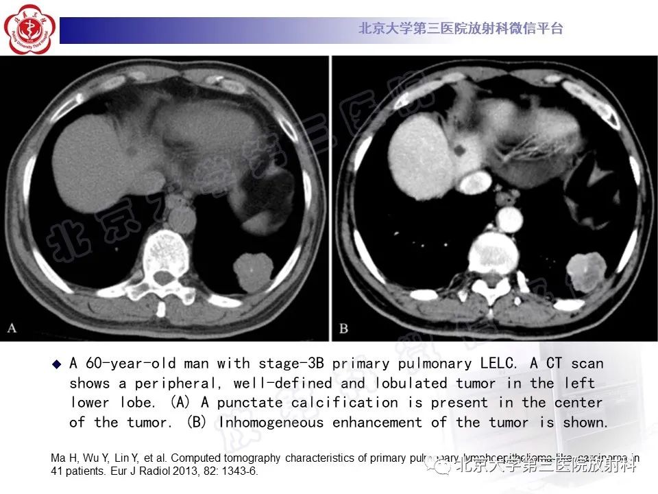 影像PPT - 【PPT】原发性肺淋巴上皮瘤样癌-20