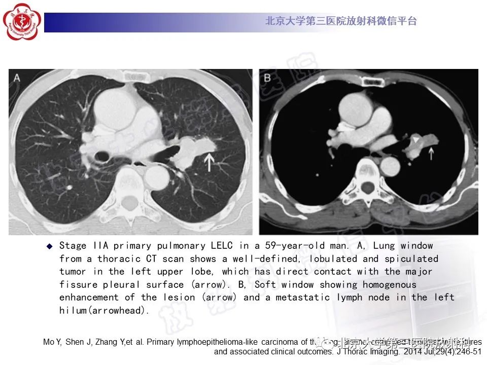 影像PPT - 【PPT】原发性肺淋巴上皮瘤样癌-21