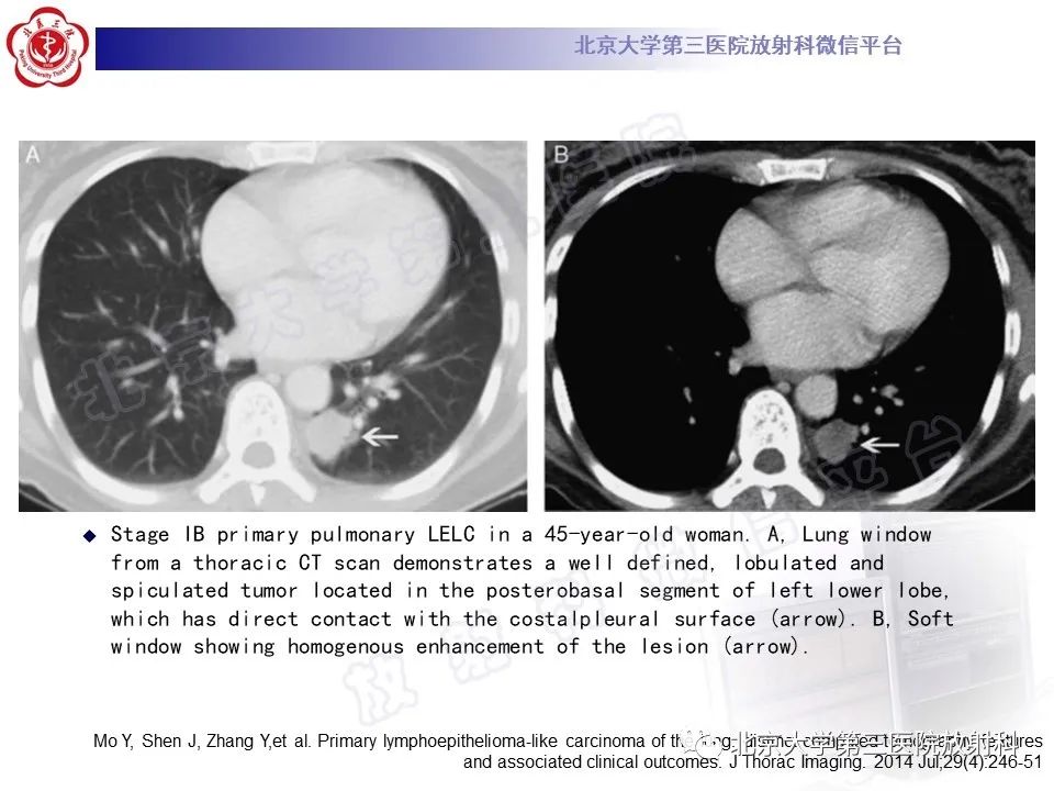 影像PPT - 【PPT】原发性肺淋巴上皮瘤样癌-22