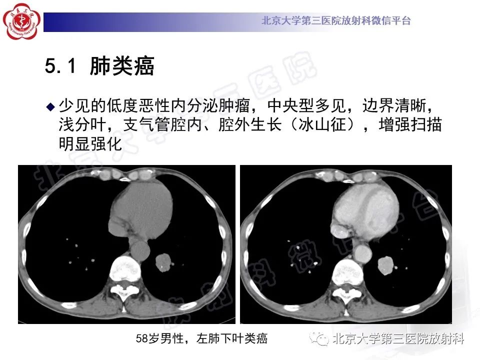 影像PPT - 【PPT】原发性肺淋巴上皮瘤样癌-25