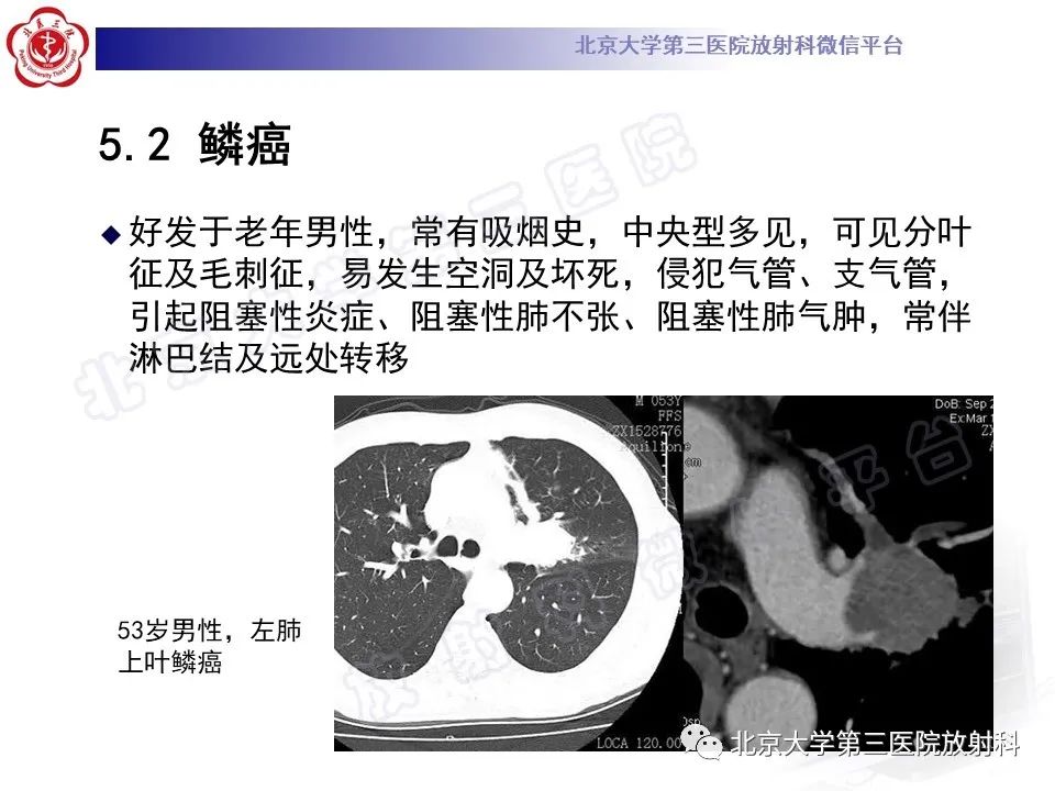 影像PPT - 【PPT】原发性肺淋巴上皮瘤样癌-26