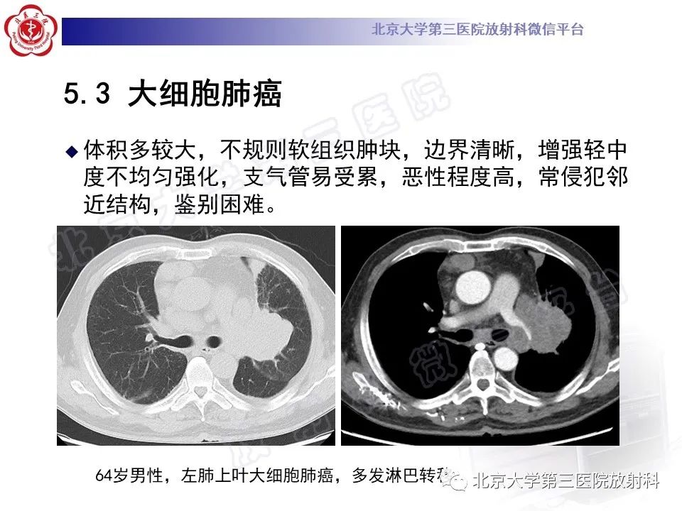 影像PPT - 【PPT】原发性肺淋巴上皮瘤样癌-27