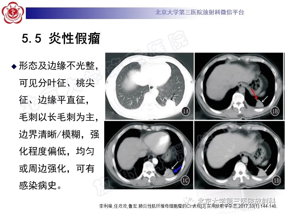 影像PPT - 【PPT】原发性肺淋巴上皮瘤样癌-29