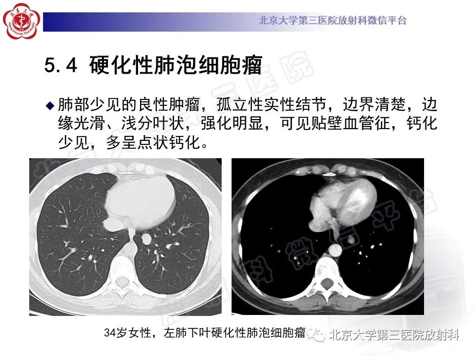 影像PPT - 【PPT】原发性肺淋巴上皮瘤样癌-28