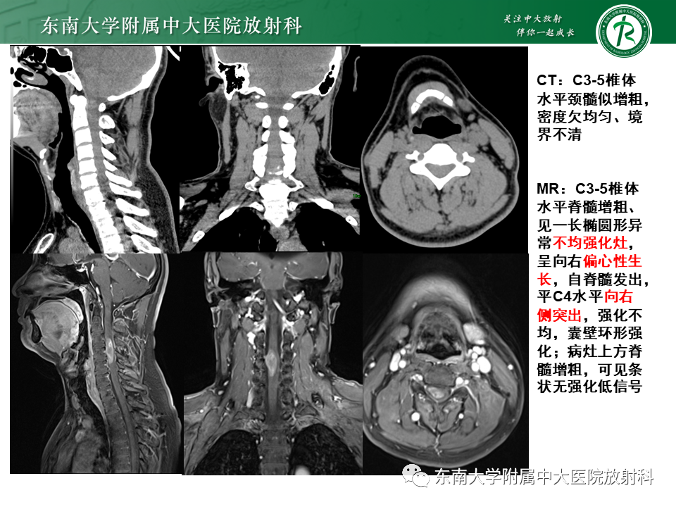 影像PPT - 【PPT】弥漫性中线胶质瘤-5 影像PPT - 【PPT】弥漫性中线胶质瘤-5