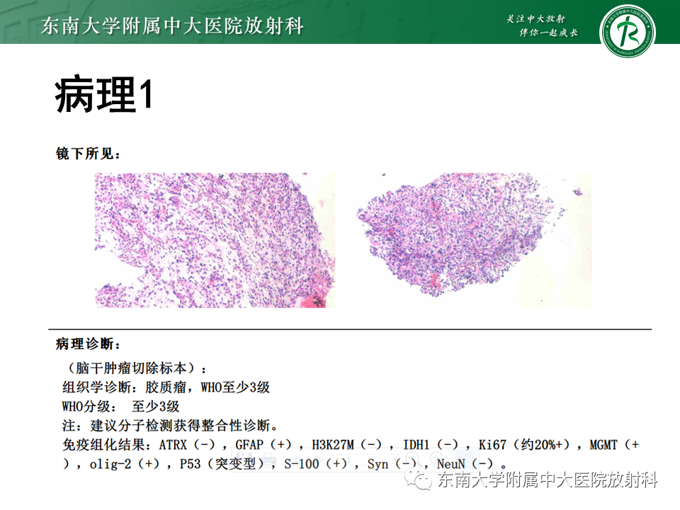 影像PPT - 【PPT】弥漫性中线胶质瘤-4 影像PPT - 【PPT】弥漫性中线胶质瘤-4