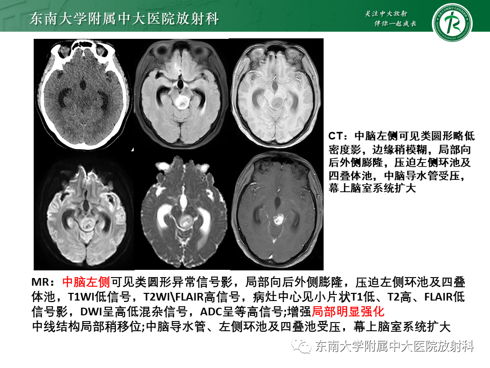 影像PPT - 【PPT】弥漫性中线胶质瘤-3 影像PPT - 【PPT】弥漫性中线胶质瘤-3