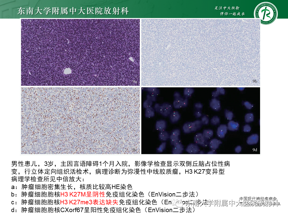 影像PPT - 【PPT】弥漫性中线胶质瘤-14 影像PPT - 【PPT】弥漫性中线胶质瘤-14