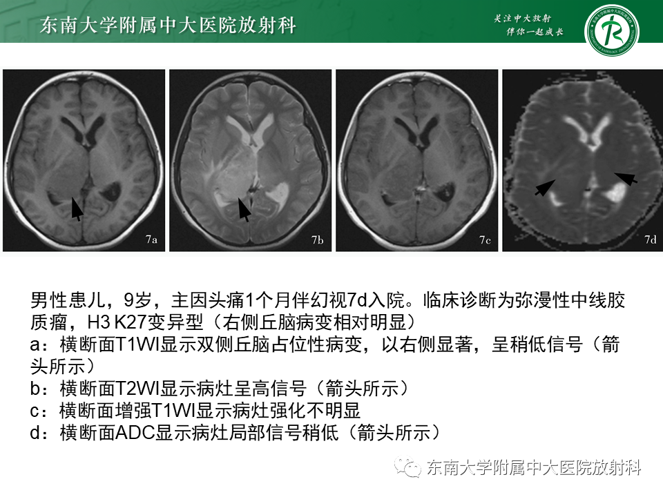 影像PPT - 【PPT】弥漫性中线胶质瘤-18 影像PPT - 【PPT】弥漫性中线胶质瘤-18