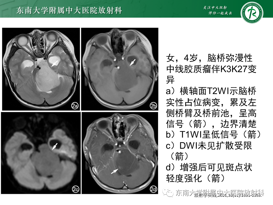 影像PPT - 【PPT】弥漫性中线胶质瘤-21 影像PPT - 【PPT】弥漫性中线胶质瘤-21