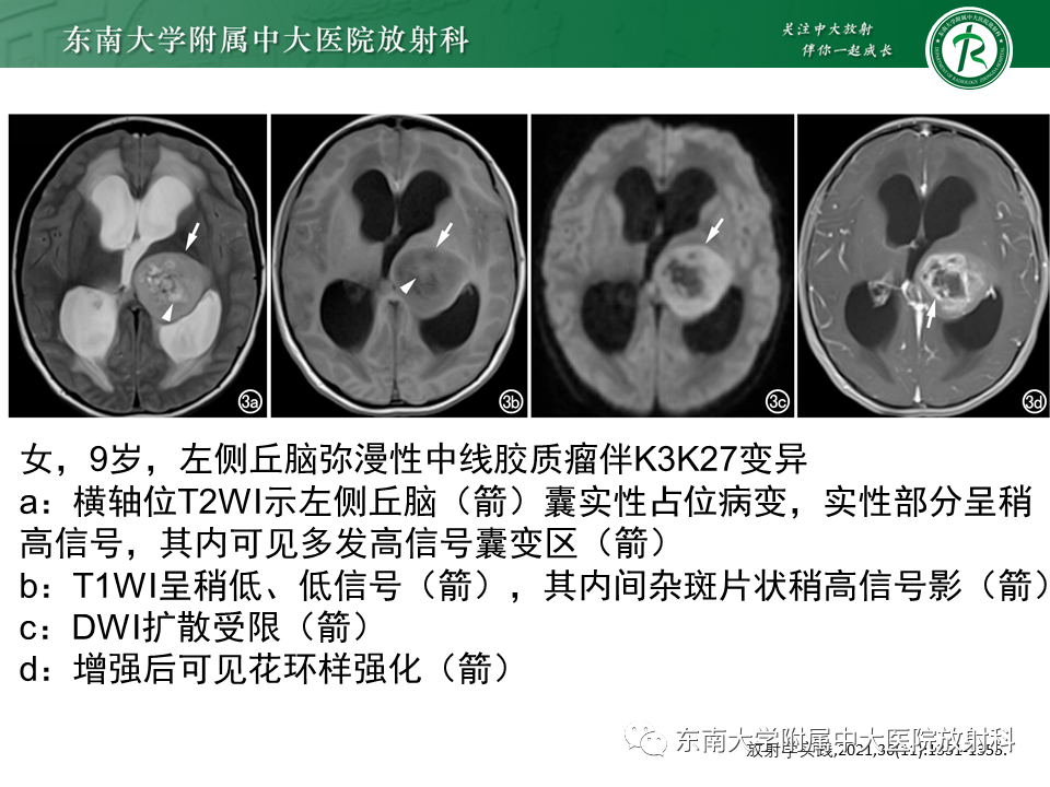 影像PPT - 【PPT】弥漫性中线胶质瘤-22 影像PPT - 【PPT】弥漫性中线胶质瘤-22