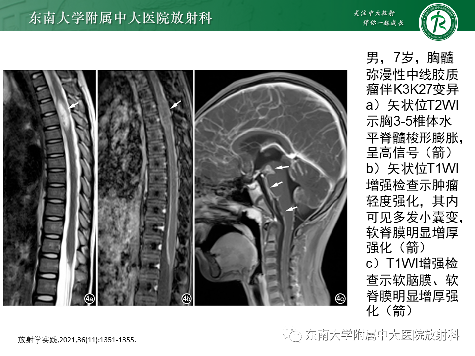影像PPT - 【PPT】弥漫性中线胶质瘤-23 影像PPT - 【PPT】弥漫性中线胶质瘤-23
