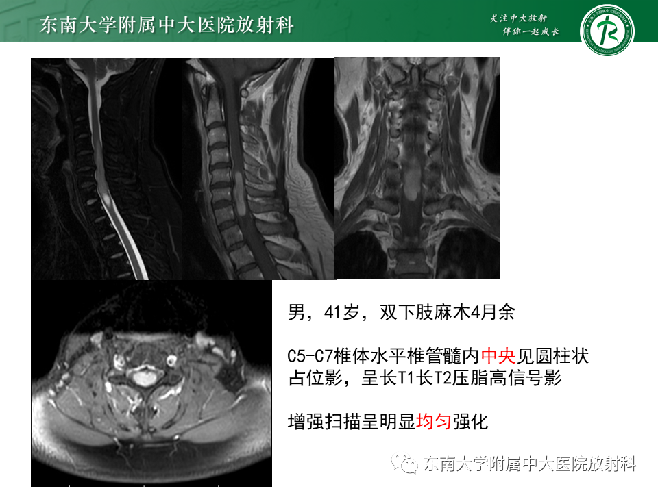 影像PPT - 【PPT】弥漫性中线胶质瘤-25 影像PPT - 【PPT】弥漫性中线胶质瘤-25