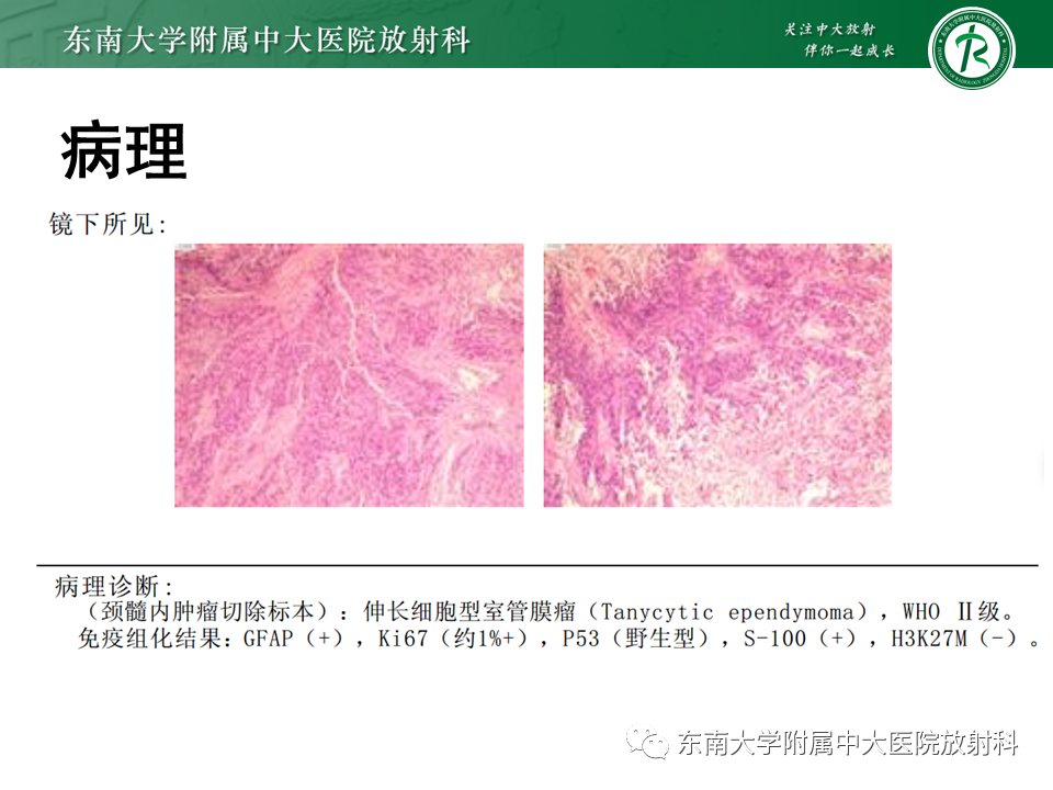 影像PPT - 【PPT】弥漫性中线胶质瘤-26 影像PPT - 【PPT】弥漫性中线胶质瘤-26