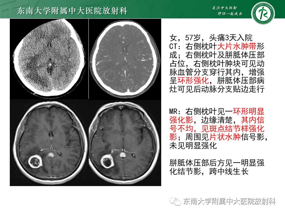 影像PPT - 【PPT】弥漫性中线胶质瘤-28 影像PPT - 【PPT】弥漫性中线胶质瘤-28
