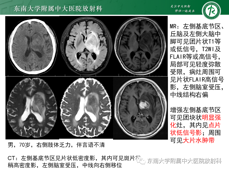影像PPT - 【PPT】弥漫性中线胶质瘤-31 影像PPT - 【PPT】弥漫性中线胶质瘤-31