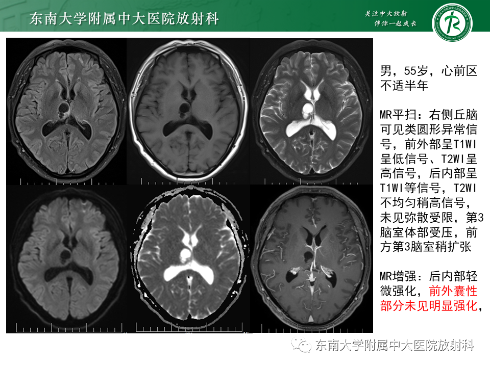 影像PPT - 【PPT】弥漫性中线胶质瘤-34 影像PPT - 【PPT】弥漫性中线胶质瘤-34