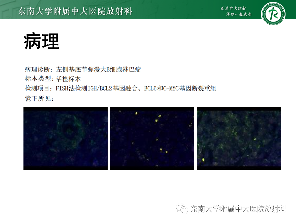 影像PPT - 【PPT】弥漫性中线胶质瘤-32 影像PPT - 【PPT】弥漫性中线胶质瘤-32