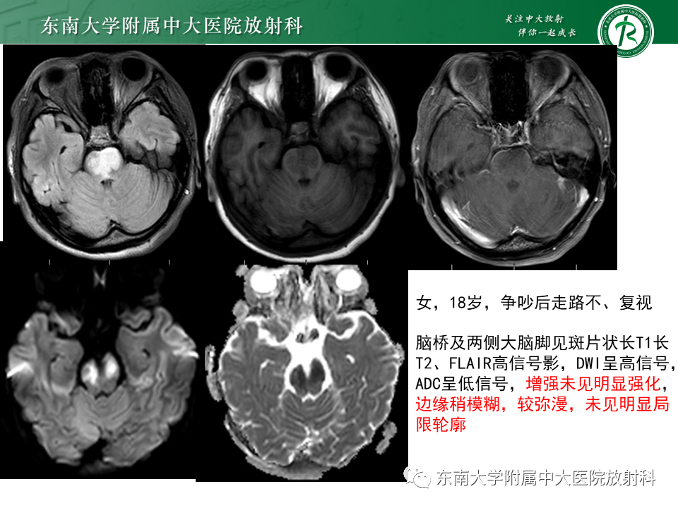 影像PPT - 【PPT】弥漫性中线胶质瘤-37 影像PPT - 【PPT】弥漫性中线胶质瘤-37