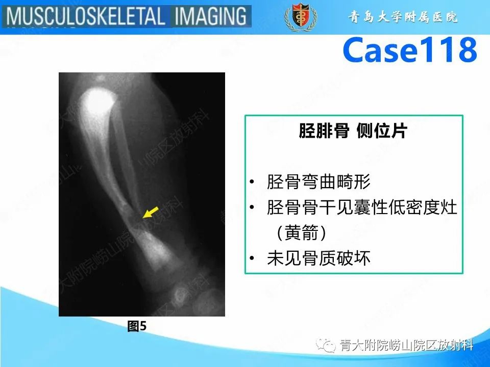 影像PPT - 【PPT】胫骨假关节：神经纤维瘤病 Ⅰ型-14
