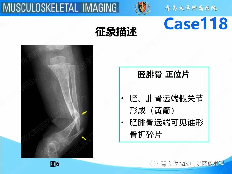 影像PPT - 【PPT】胫骨假关节：神经纤维瘤病 Ⅰ型-24