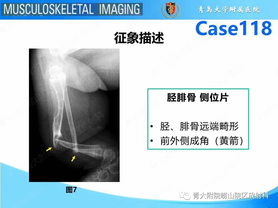 影像PPT - 【PPT】胫骨假关节：神经纤维瘤病 Ⅰ型-25