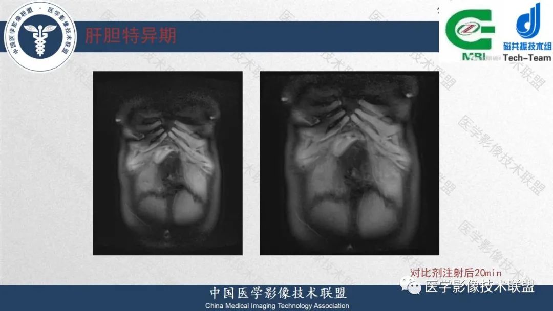 影像PPT - 【PPT】肝脏磁共振规范化扫描特异性对比剂增强MR—扫描方案与经验分享-35